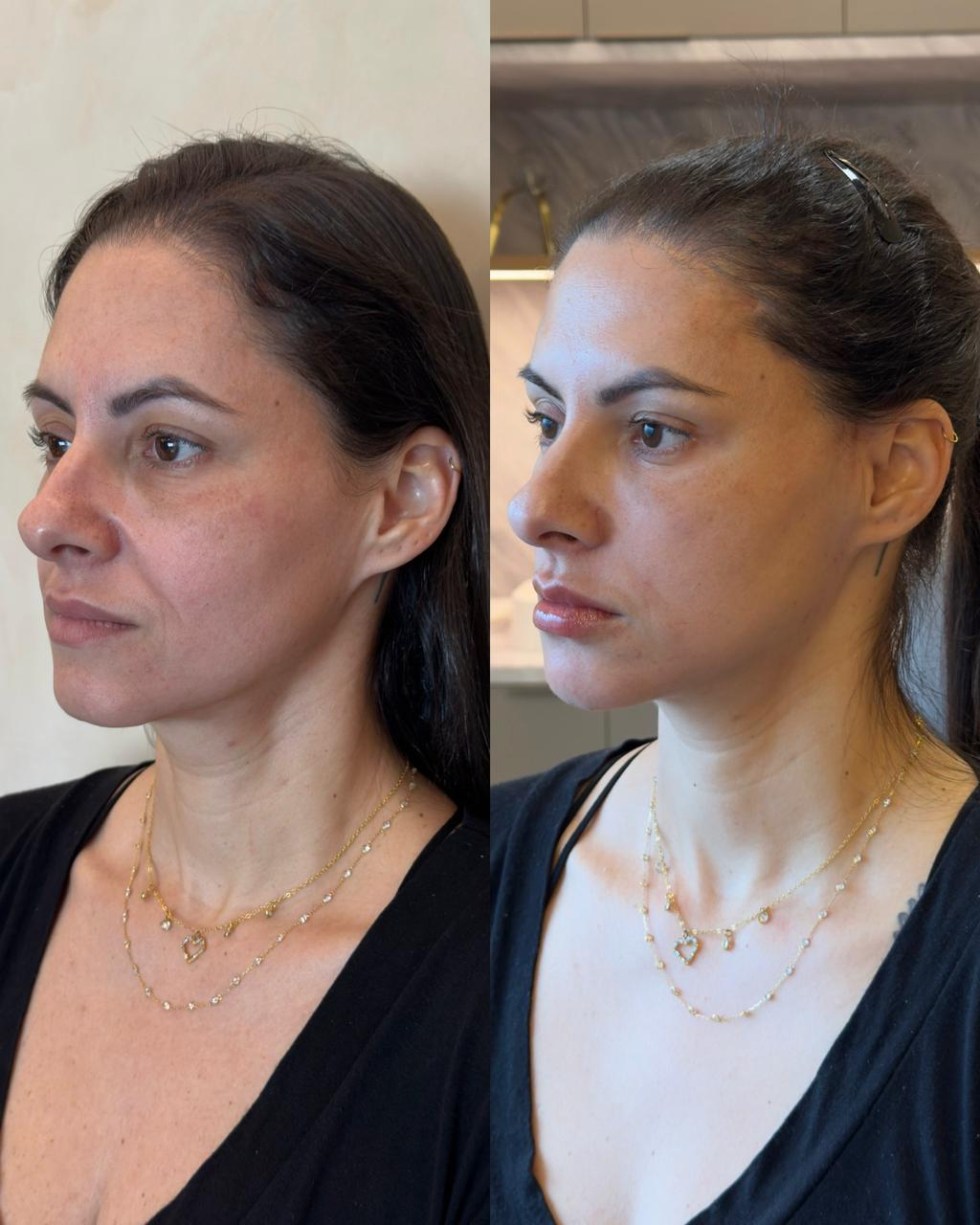 Técnica Single Face