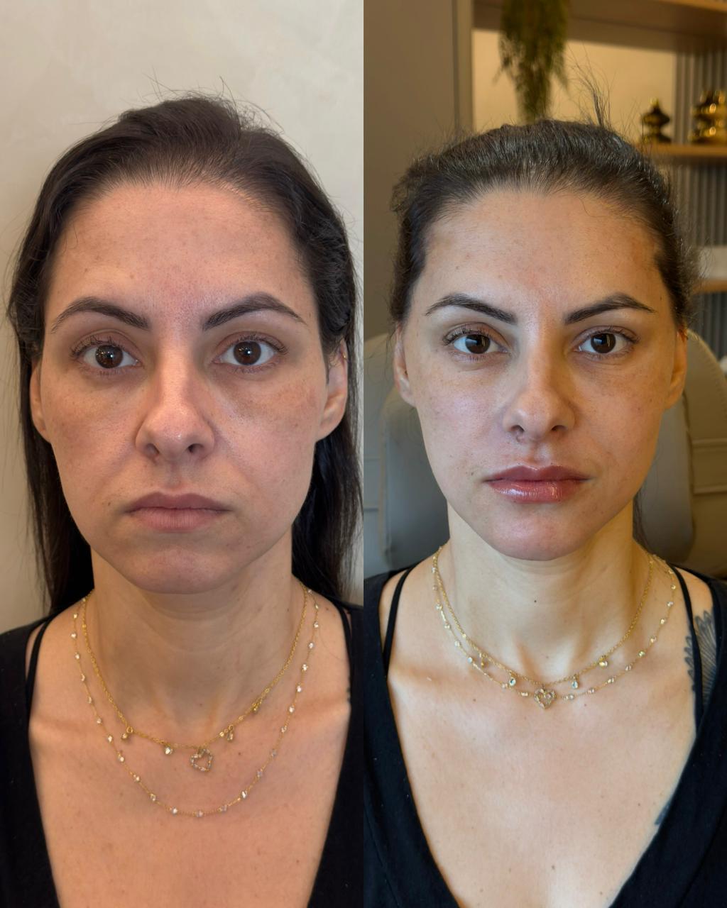 Técnica Single Face