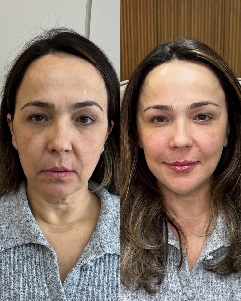 Técnica Single Face