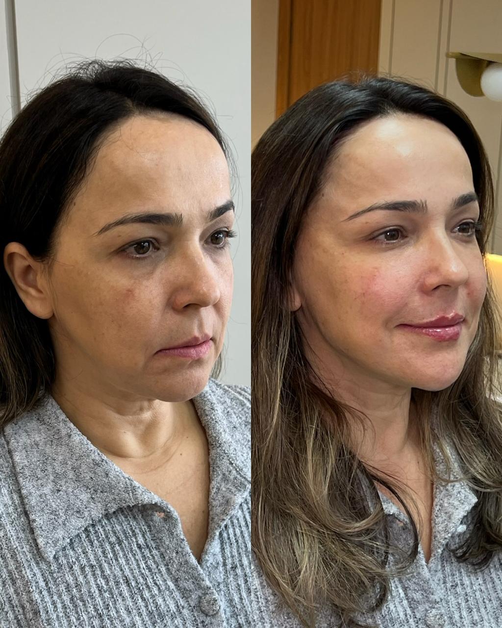 Técnica Single Face