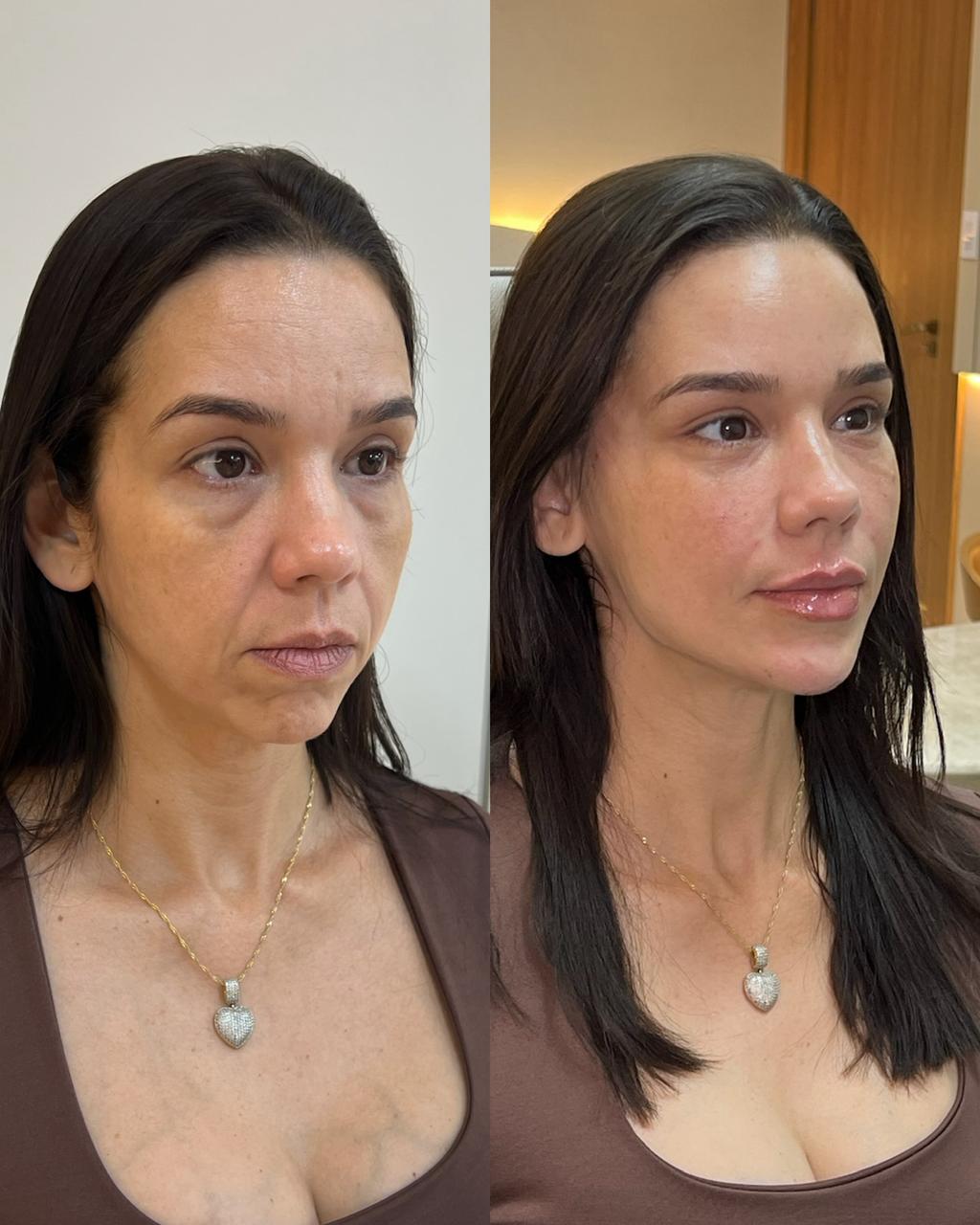 Técnica Single Face