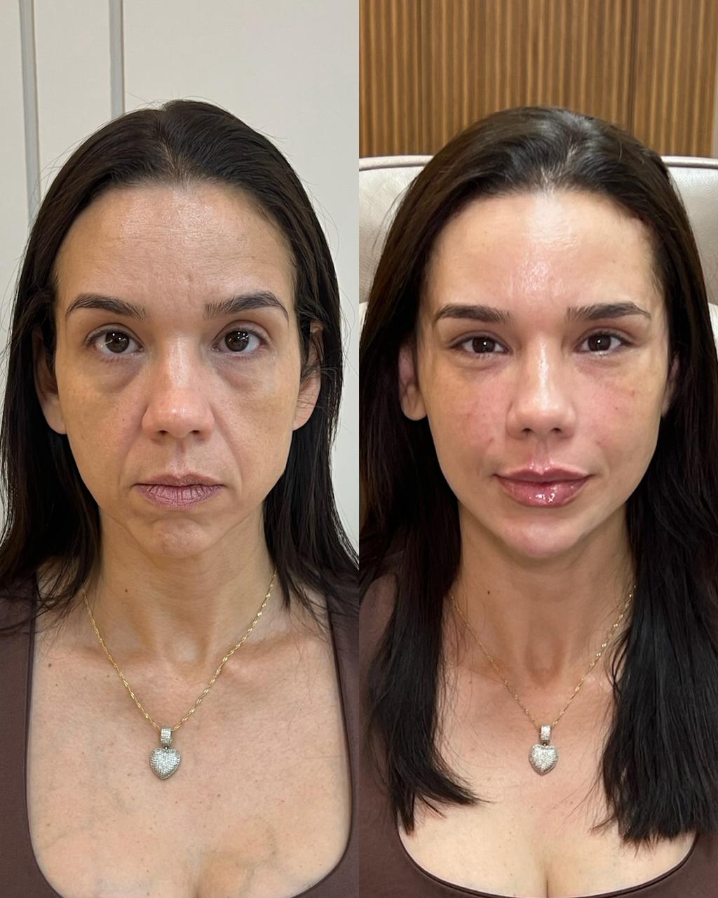 Técnica Single Face